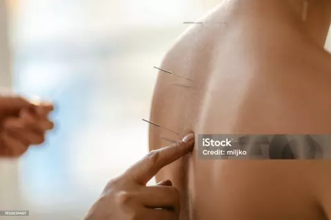 Akupunktur Behandlung